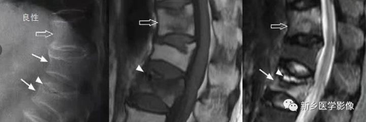 11种方法告诉您是压缩骨折还是转移 11种方法告诉您是压缩骨折还是转移