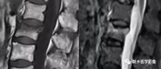 11种方法告诉您是压缩骨折还是转移 11种方法告诉您是压缩骨折还是转移