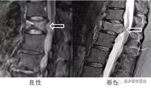 11种方法告诉您是压缩骨折还是转移 11种方法告诉您是压缩骨折还是转移