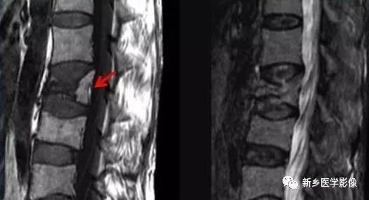 11种方法告诉您是压缩骨折还是转移 11种方法告诉您是压缩骨折还是转移