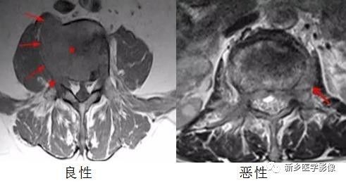 11种方法告诉您是压缩骨折还是转移 11种方法告诉您是压缩骨折还是转移