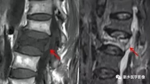 11种方法告诉您是压缩骨折还是转移 11种方法告诉您是压缩骨折还是转移