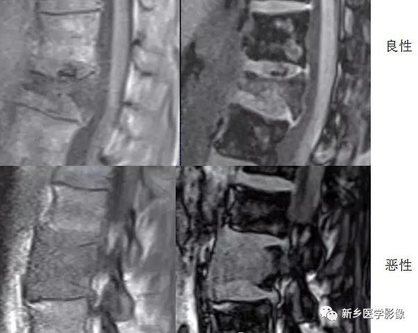 11种方法告诉您是压缩骨折还是转移 11种方法告诉您是压缩骨折还是转移