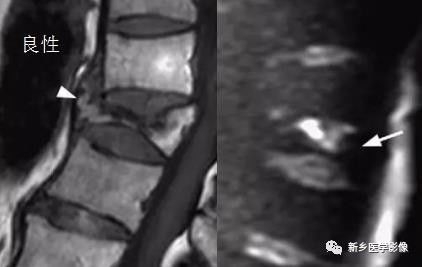 11种方法告诉您是压缩骨折还是转移 11种方法告诉您是压缩骨折还是转移