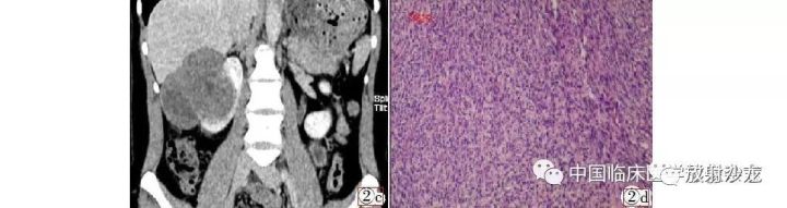 【病例】原发性肾脏滑膜肉瘤CT误诊2例 【病例】原发性肾脏滑膜肉瘤CT误诊2例
