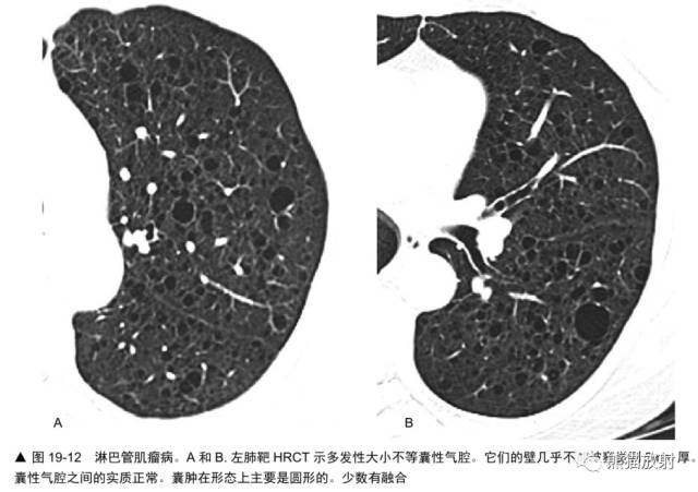 肺淋巴管肌瘤病（LAM）的诊断与鉴别诊断