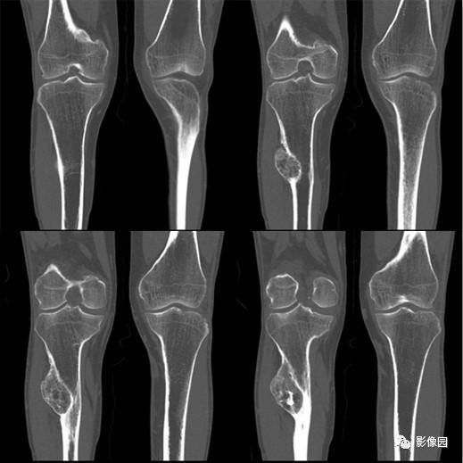 【病例】胫骨骨软骨瘤1例CT