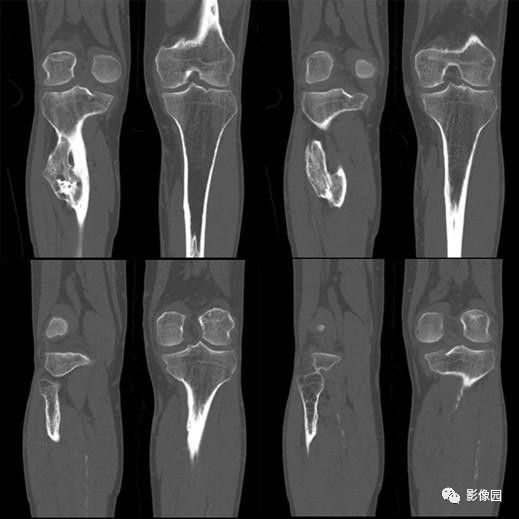 【病例】胫骨骨软骨瘤1例CT 【病例】胫骨骨软骨瘤1例CT