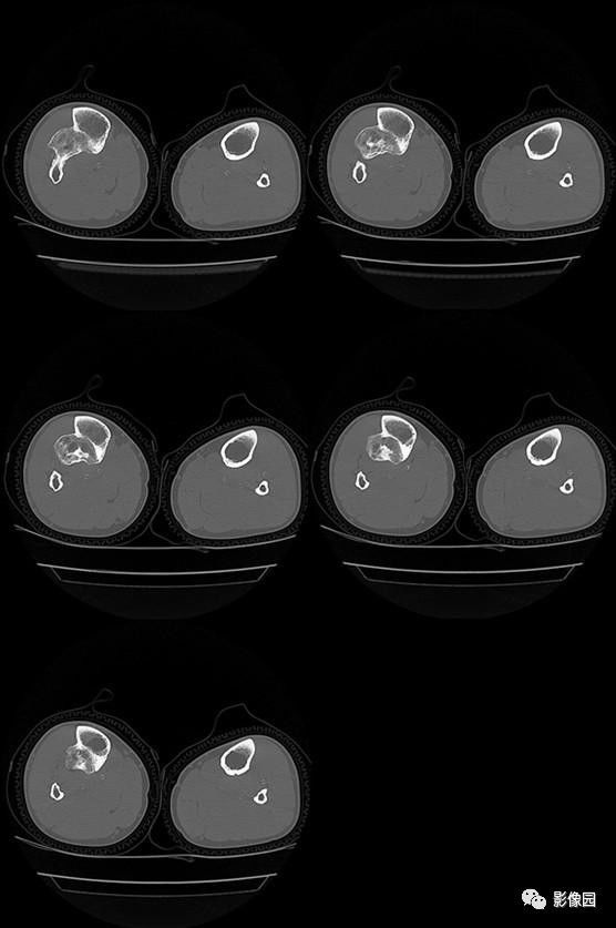 【病例】胫骨骨软骨瘤1例CT 【病例】胫骨骨软骨瘤1例CT