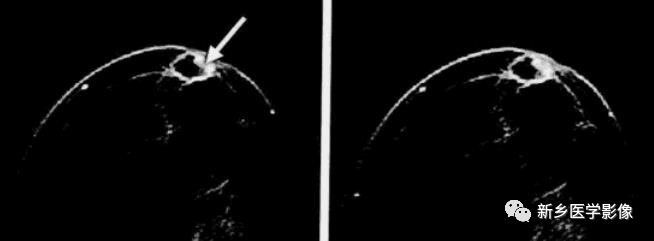 诊断乳腺的病变的主要可靠征象