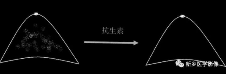 诊断乳腺的病变的主要可靠征象