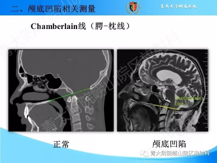 【PPT】颅颈交界区相关影像学测量