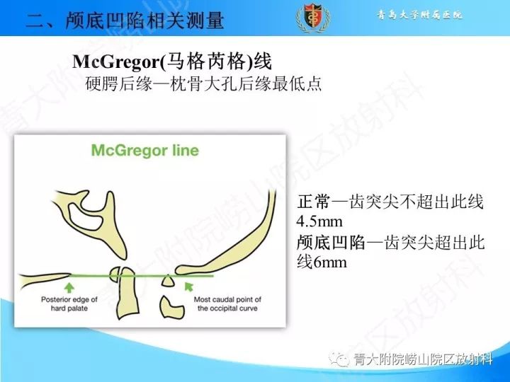 【PPT】颅颈交界区相关影像学测量