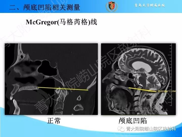【PPT】颅颈交界区相关影像学测量