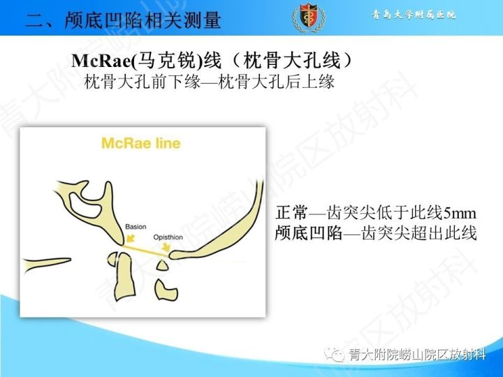 【PPT】颅颈交界区相关影像学测量