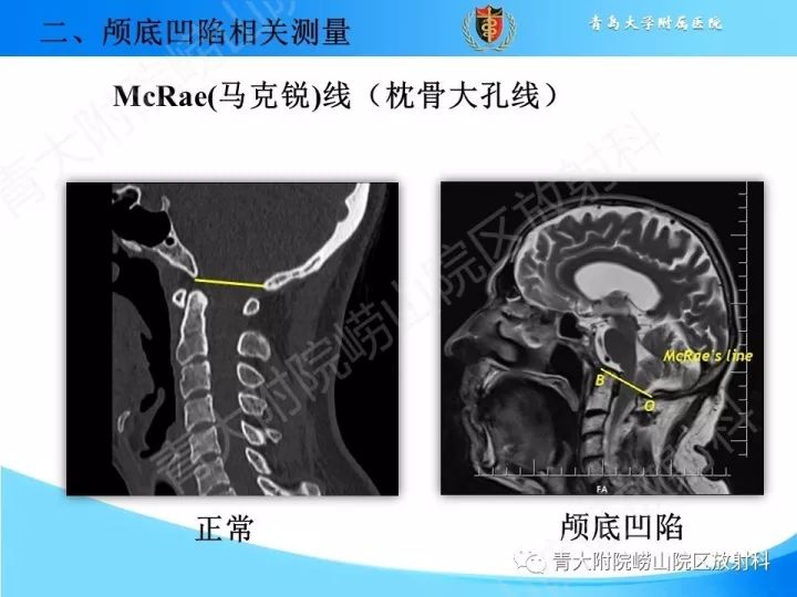 【PPT】颅颈交界区相关影像学测量