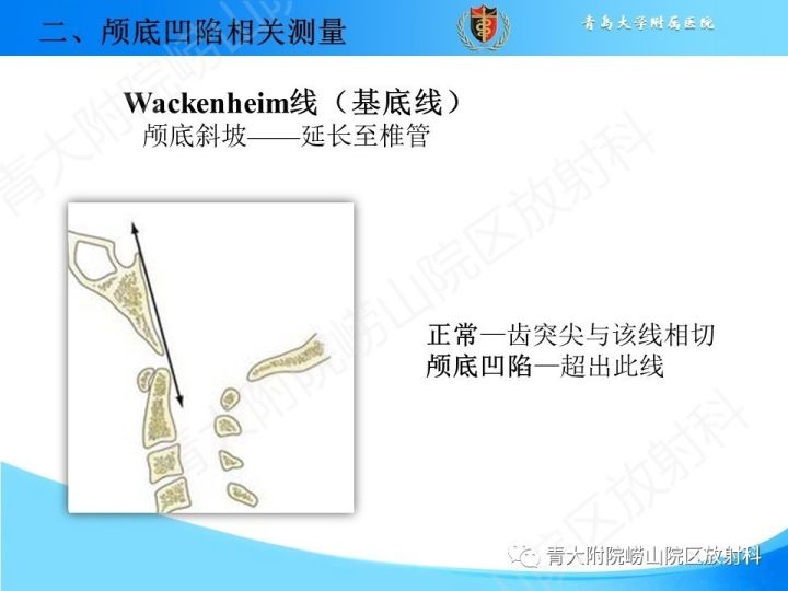 【PPT】颅颈交界区相关影像学测量