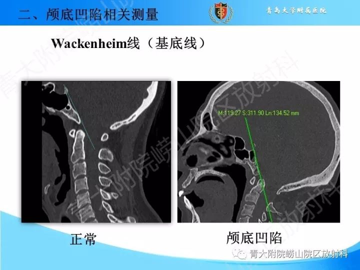 【PPT】颅颈交界区相关影像学测量