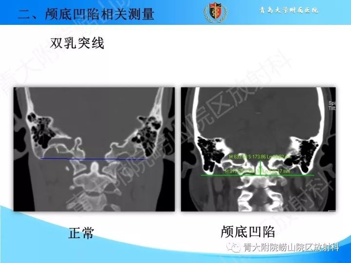 【PPT】颅颈交界区相关影像学测量