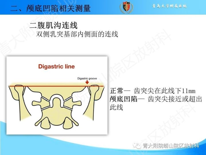 【PPT】颅颈交界区相关影像学测量