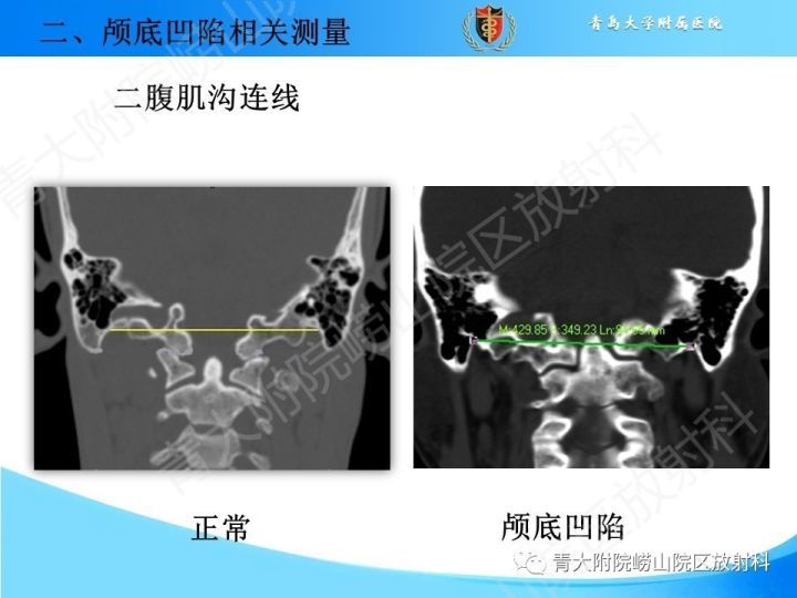 【PPT】颅颈交界区相关影像学测量