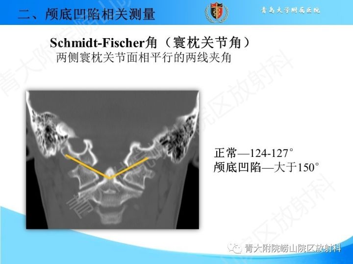 【PPT】颅颈交界区相关影像学测量