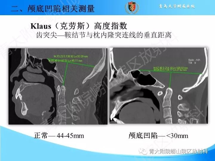 【PPT】颅颈交界区相关影像学测量