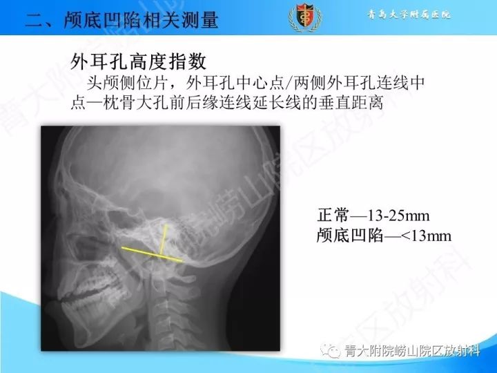 【PPT】颅颈交界区相关影像学测量