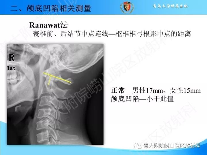 【PPT】颅颈交界区相关影像学测量