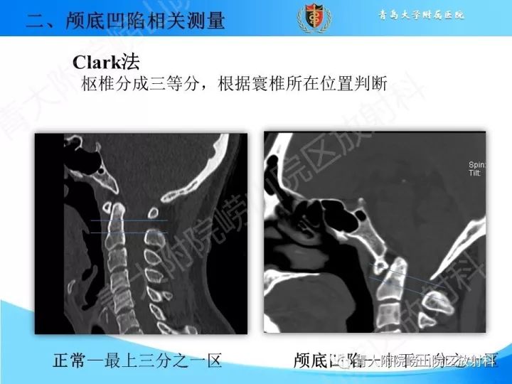 【PPT】颅颈交界区相关影像学测量