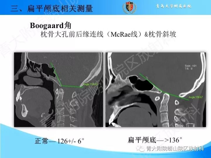 【PPT】颅颈交界区相关影像学测量