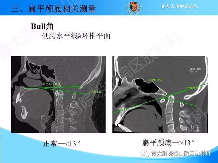 【PPT】颅颈交界区相关影像学测量
