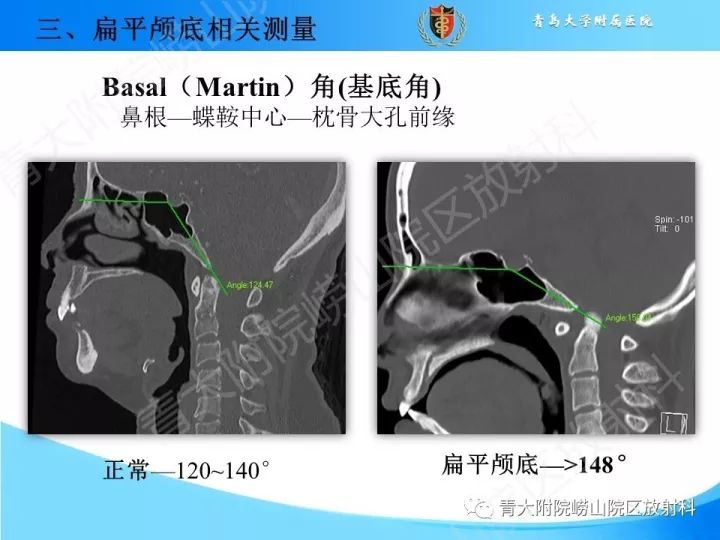 【PPT】颅颈交界区相关影像学测量