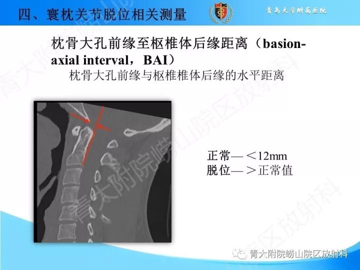【PPT】颅颈交界区相关影像学测量
