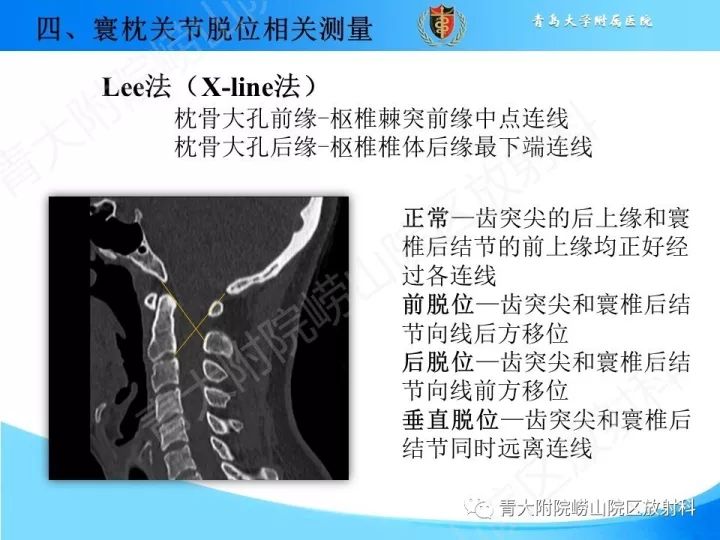 【PPT】颅颈交界区相关影像学测量