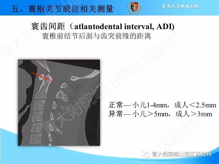 【PPT】颅颈交界区相关影像学测量
