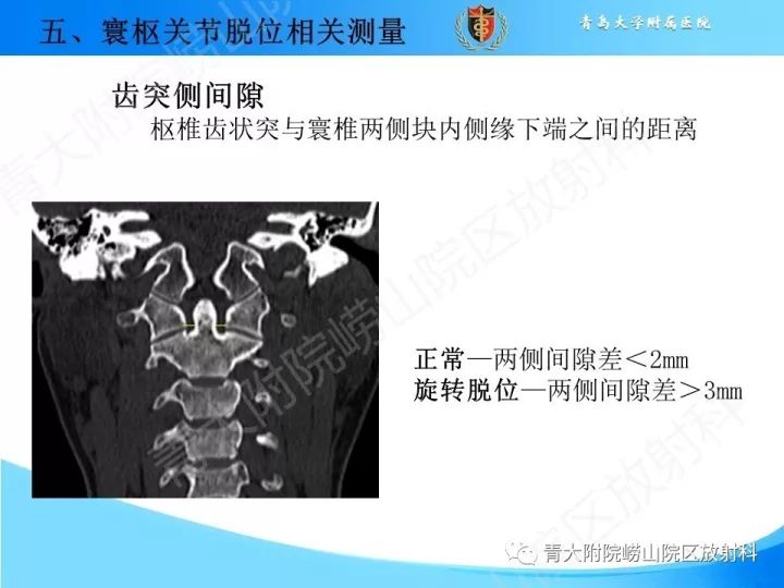 【PPT】颅颈交界区相关影像学测量