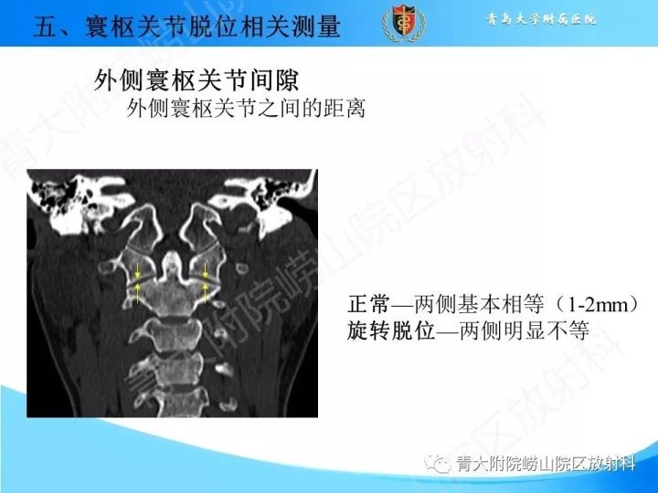 【PPT】颅颈交界区相关影像学测量