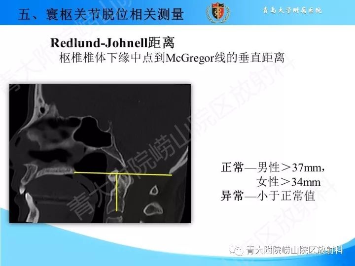【PPT】颅颈交界区相关影像学测量