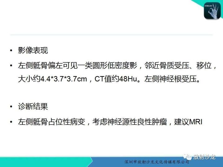 【病例】骶骨神经纤维瘤1例CT及MR