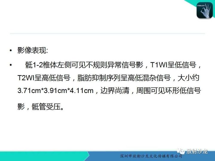【病例】骶骨神经纤维瘤1例CT及MR