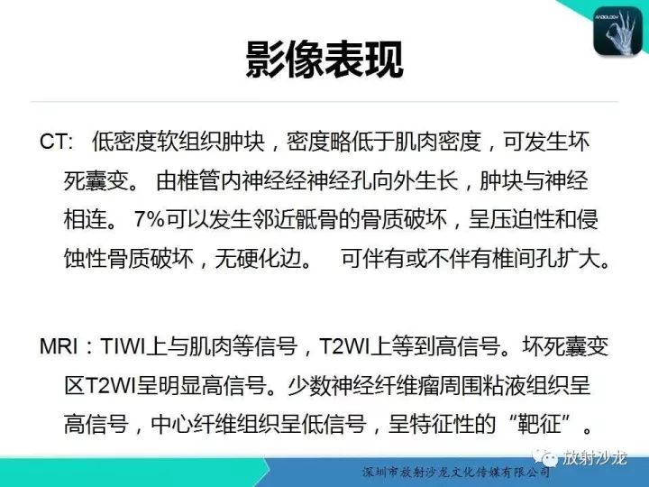 【病例】骶骨神经纤维瘤1例CT及MR
