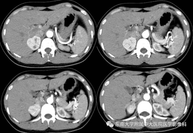 【病例】嗜铬细胞瘤2例CT影像表现