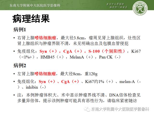 【病例】嗜铬细胞瘤2例CT影像表现