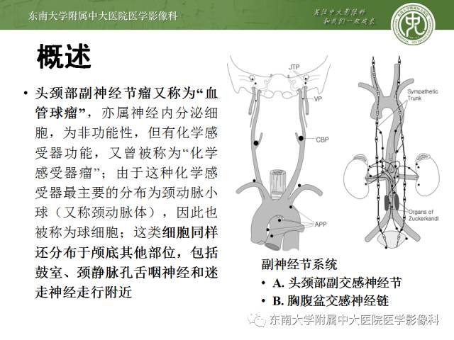 【病例】嗜铬细胞瘤2例CT影像表现