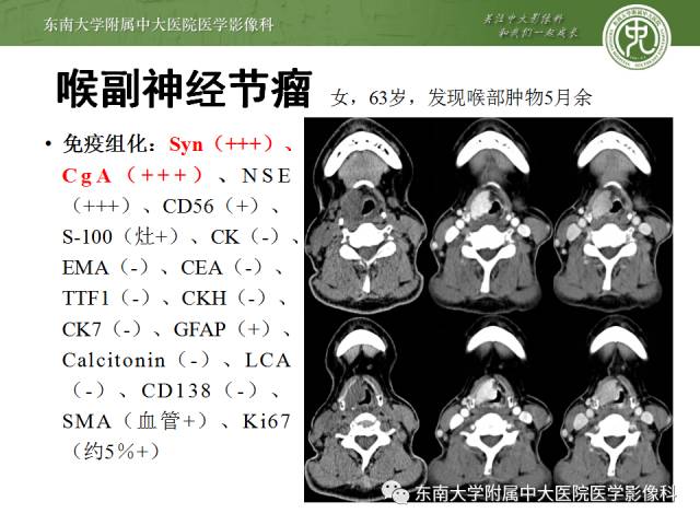 【病例】嗜铬细胞瘤2例CT影像表现