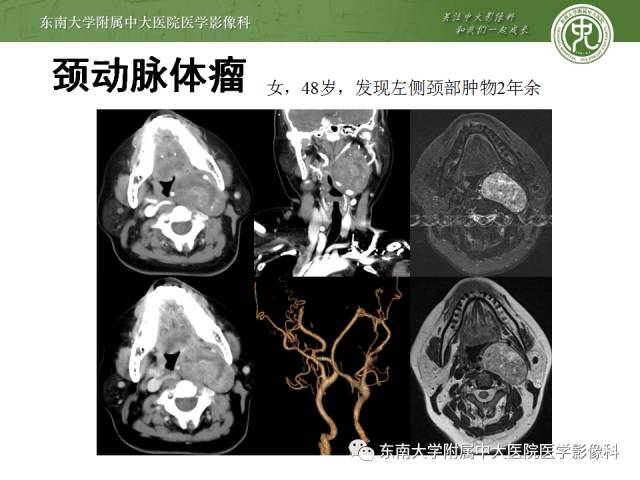 【病例】嗜铬细胞瘤2例CT影像表现
