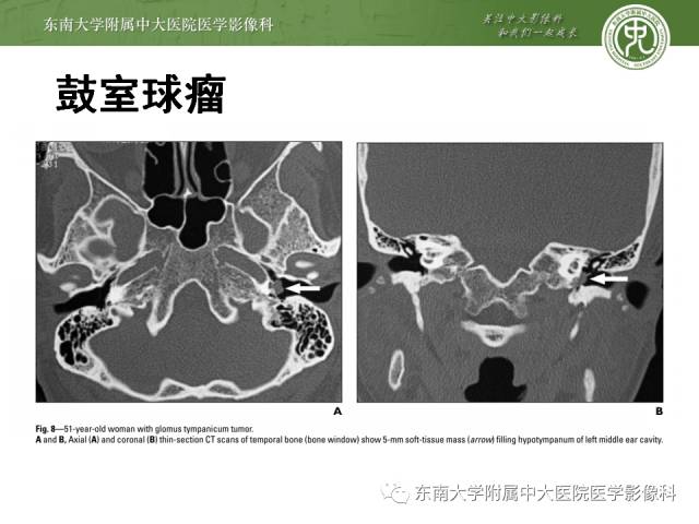 【病例】嗜铬细胞瘤2例CT影像表现