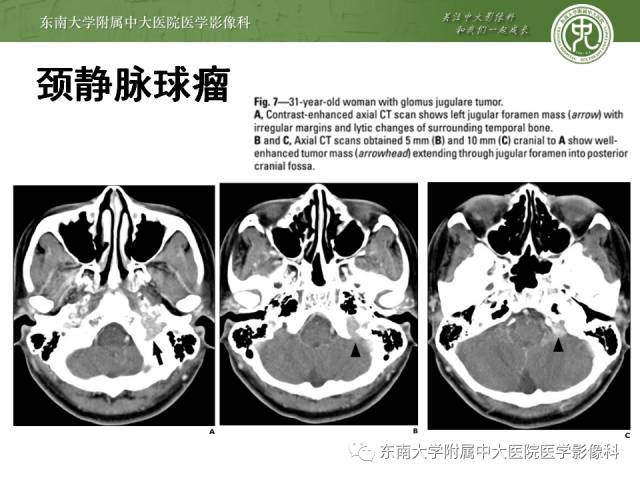 【病例】嗜铬细胞瘤2例CT影像表现