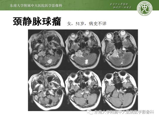 【病例】嗜铬细胞瘤2例CT影像表现